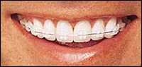 Ceramic Braces