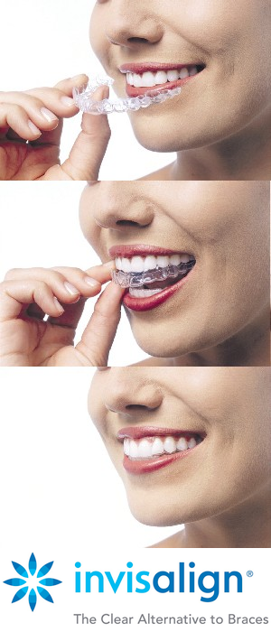 Invisalign